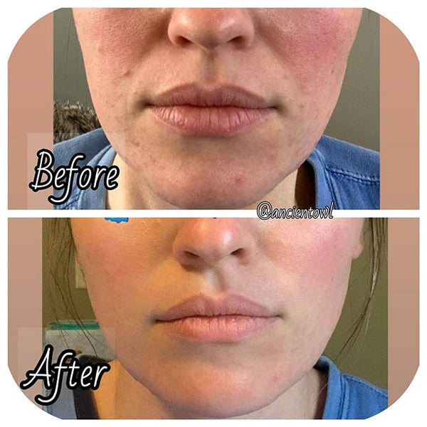 Extremely dry and sensitive skin