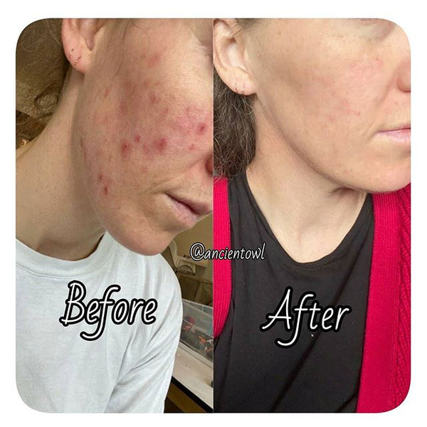 36yrs old and finally no more acne