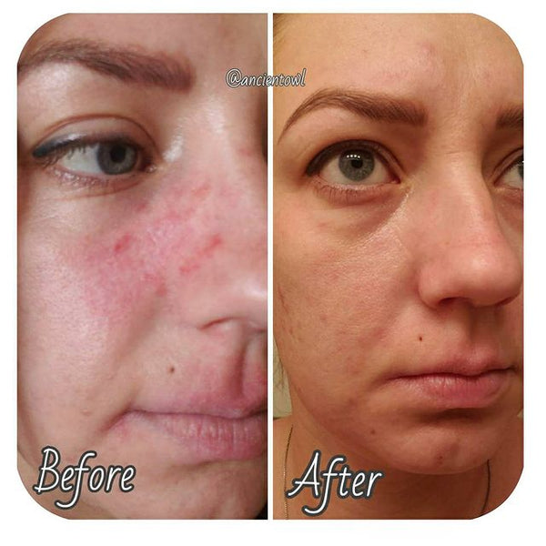 Helps with psoriasis