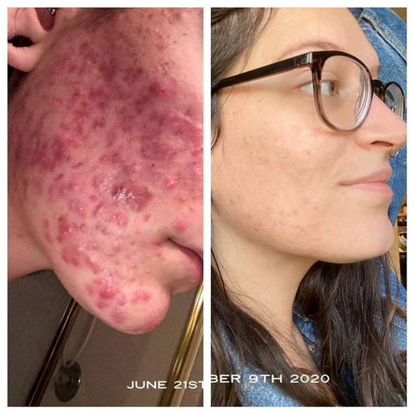 Hyperpigmentation