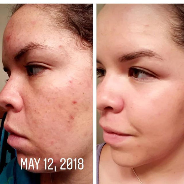 I can hardly believe the difference in my skin!