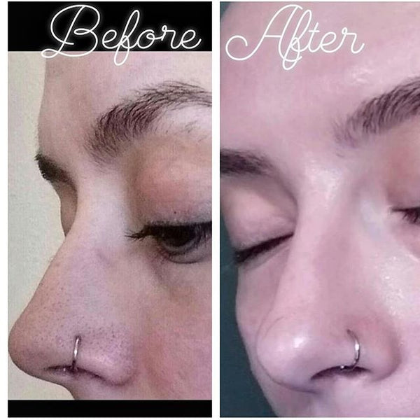 No more Blackheads