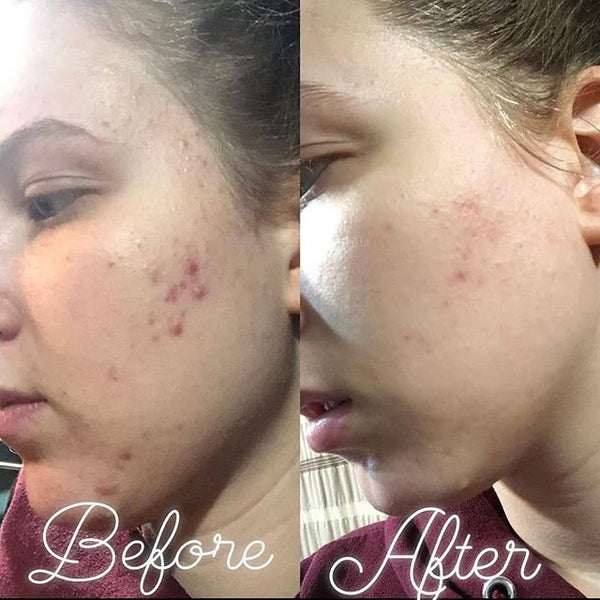 No more painful cystic acne!