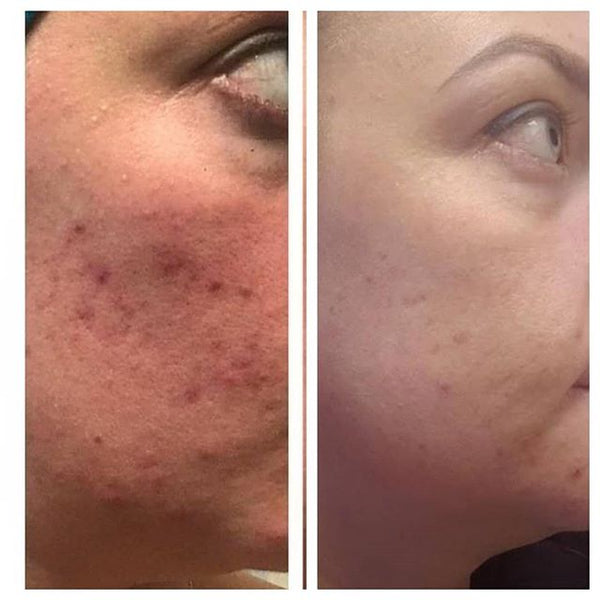 Healing deep acne scars