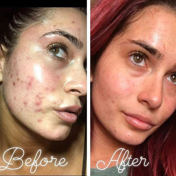Natural and effective way of clearing acne.