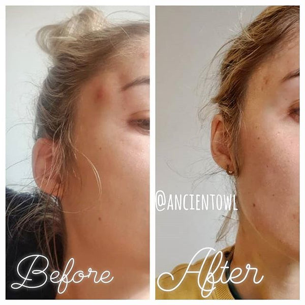 No more painful cystic zits!