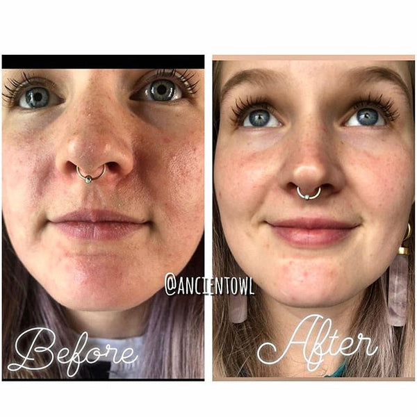 My dermatitis cleared up in less than 2 weeks