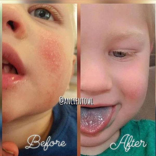 Game changer for my little boys eczema