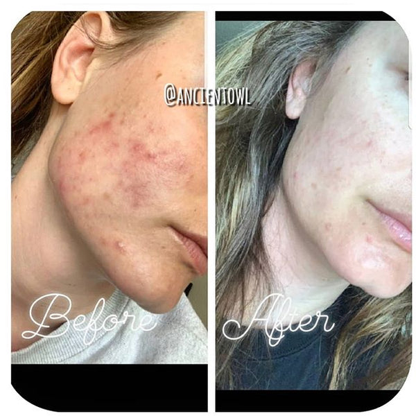 I had terrible hormonal cystic acne