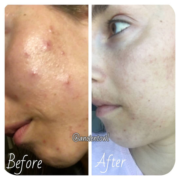 Helped heal my skin