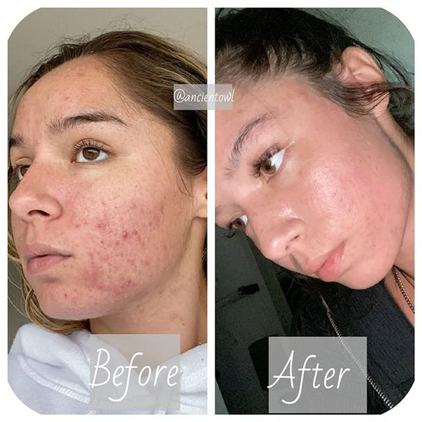 Hormonal Cystic Acne