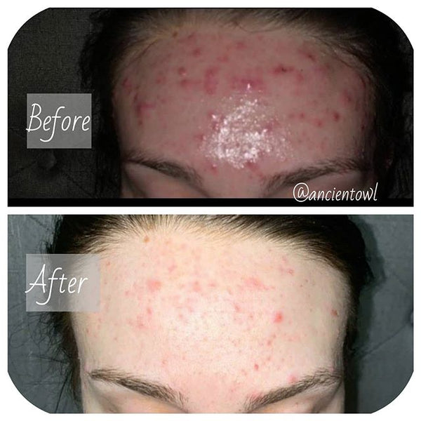 Postpartum Acne