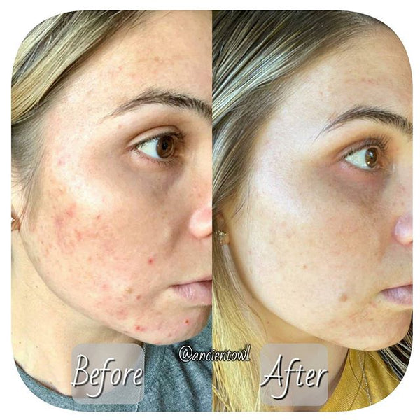 I have officially broken my habit of picking at my skin